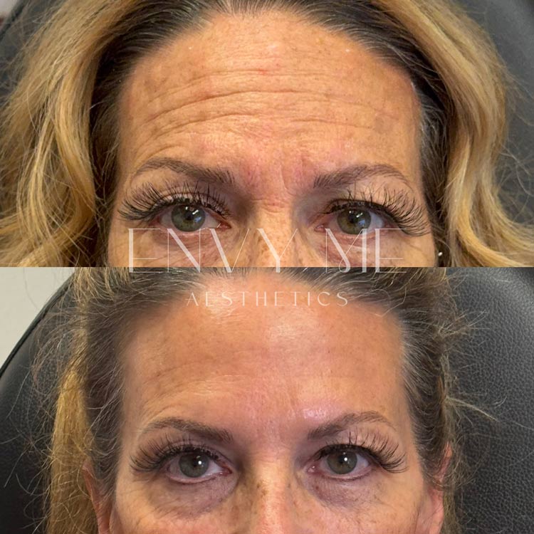Before and after of an upperface neurotoxin treatment
