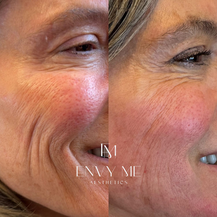 Before and after Sculptra treatment