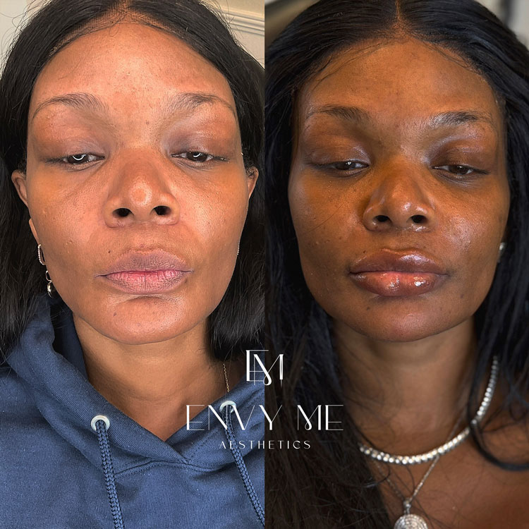Before and after of mid and lower face dermal filler
