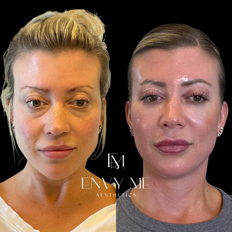 Before and after of a full face dermal filler, neurotoxins, and sculptra treatment