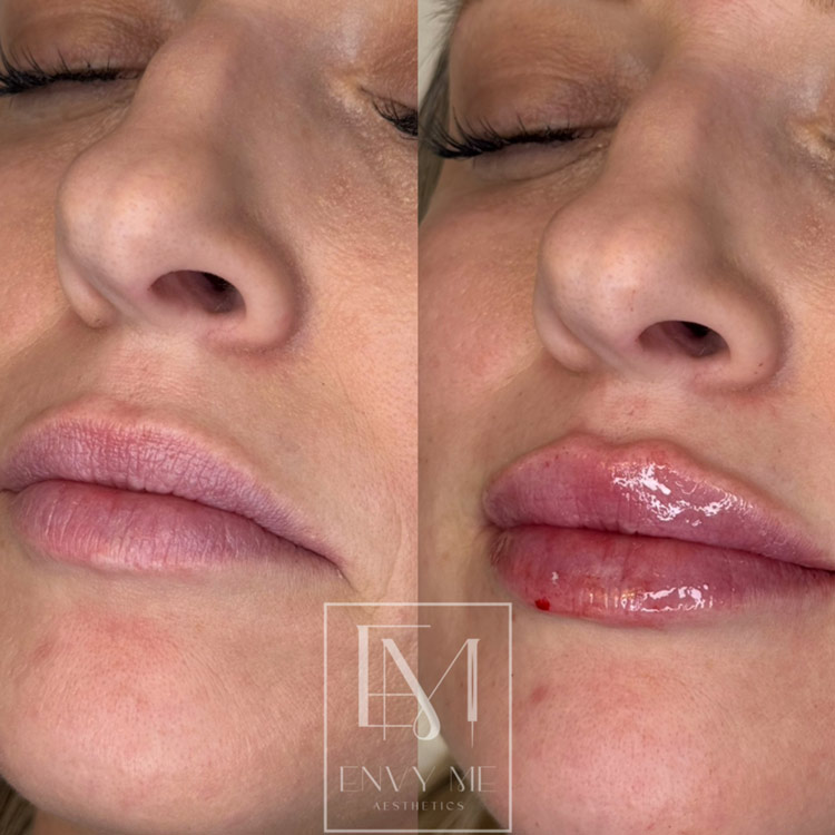 Before and after of a lip filler treatment