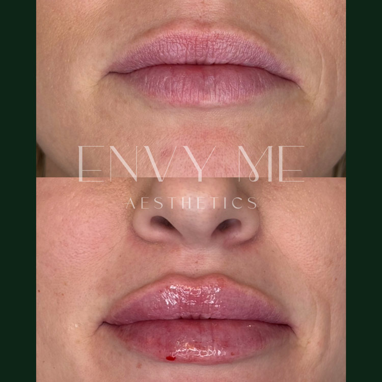Before and after of a lip filler treatment