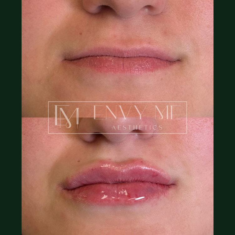 Before and after of a lip filler treatment