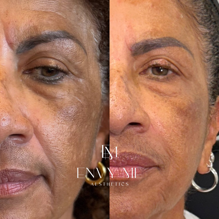 Before and after of a VI chemical peel treatment