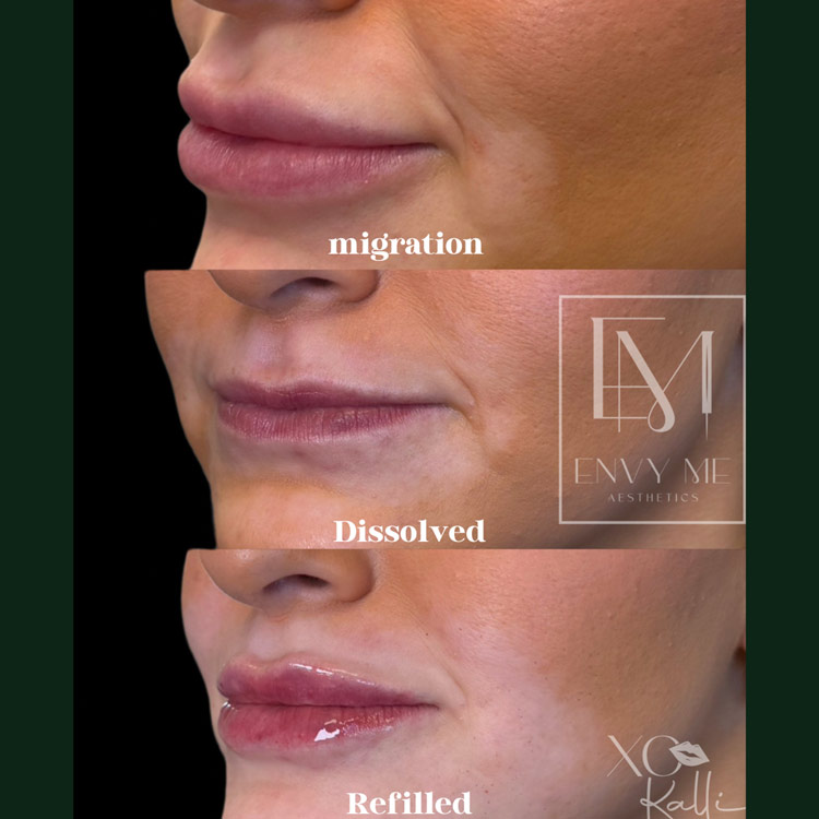 Before and after of a lip filler treatment