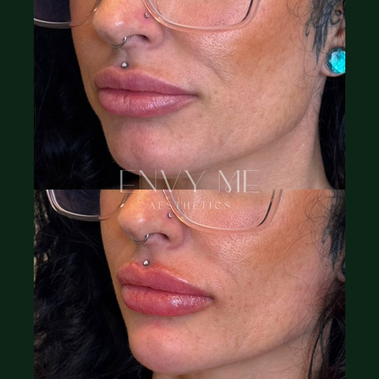 Before and after of a lip and chin filler treatment