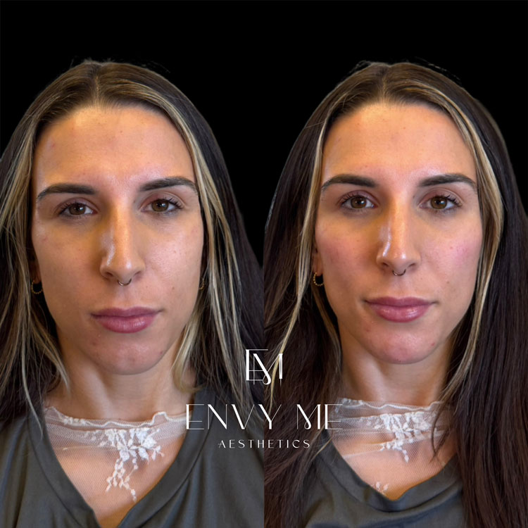 Before and after of a cheek filler treatment