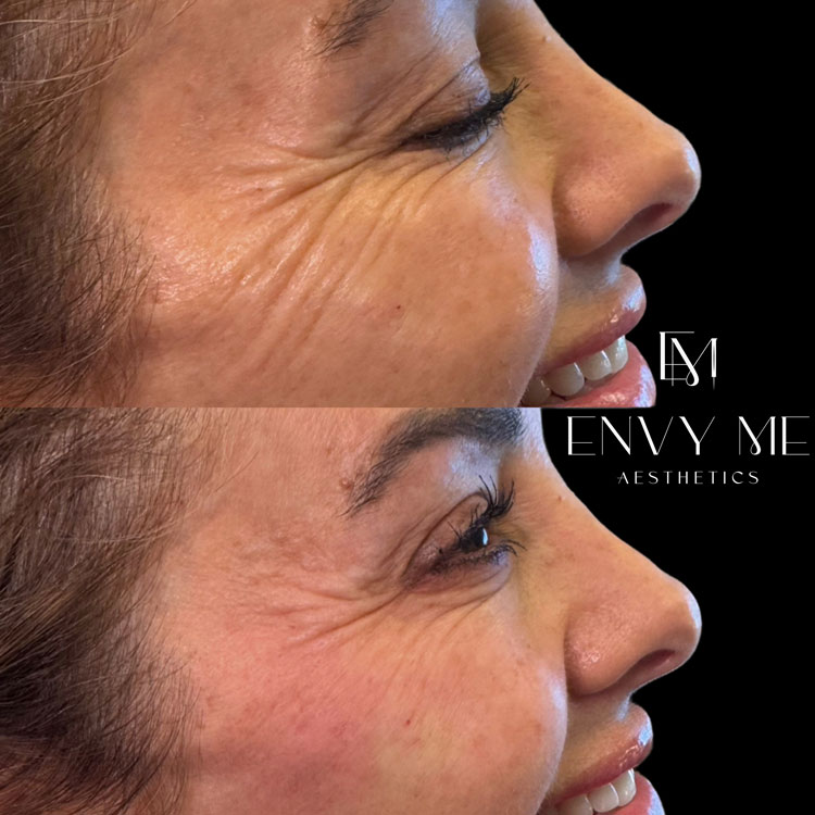 Before and after of dermal filler for radial lines