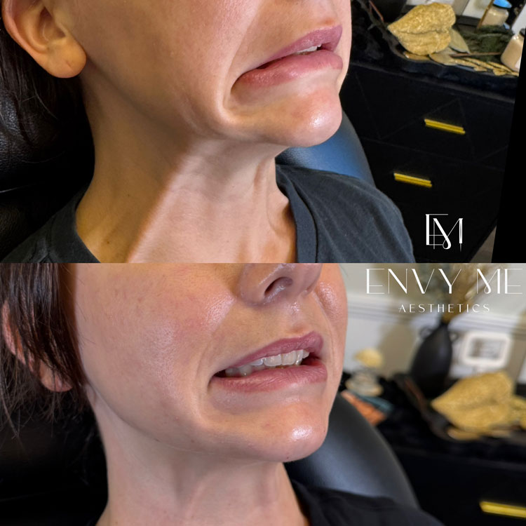 Before and after of a lower face neurotoxin treatment