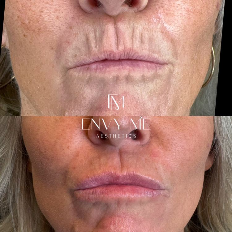 Before and after of pucker lines and lip filler treatment