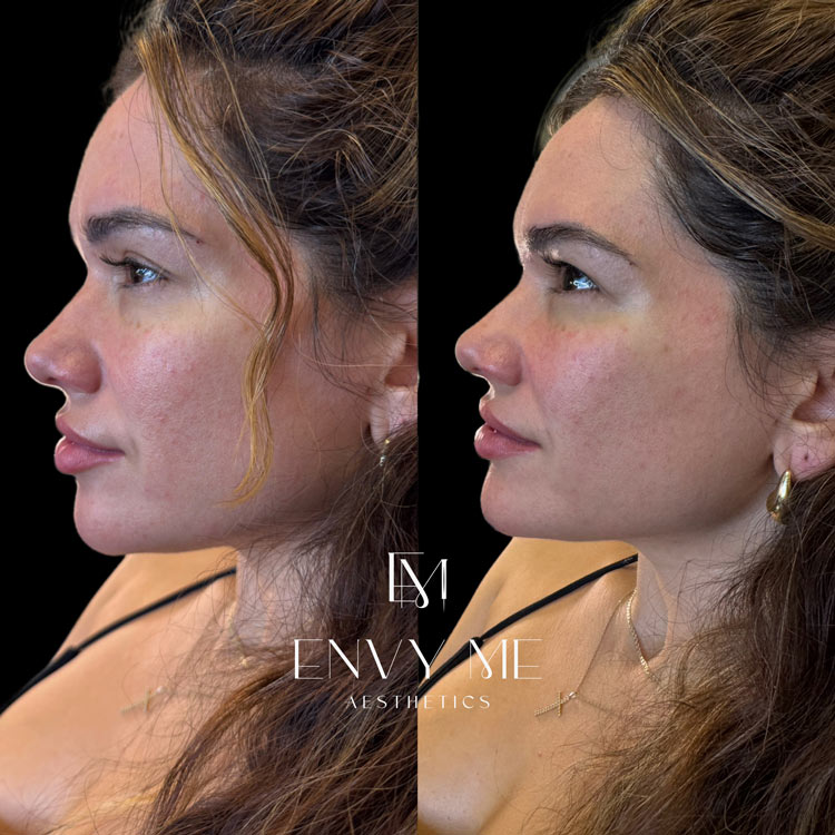 Before and after of a jawline contouring treatment
