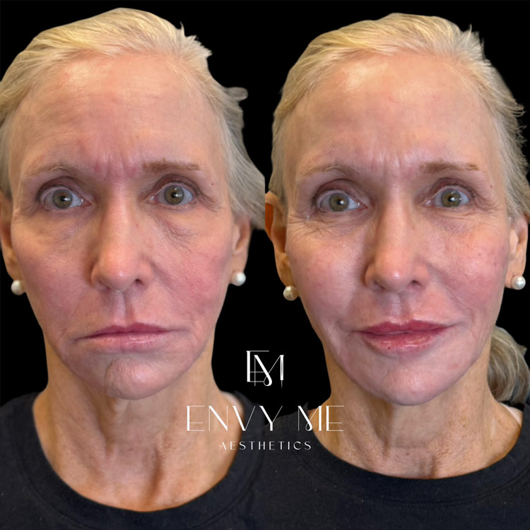 Before and after of a full facial balancing and volume replacement treatment