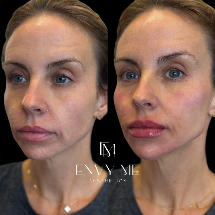 Before and after of a full facial balancing treatment