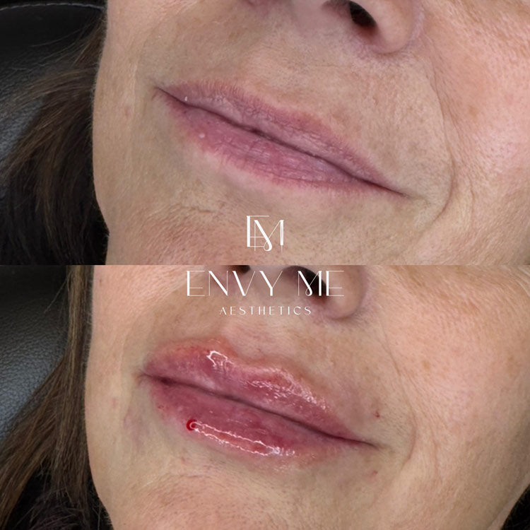 Before and after of a lip filler treatment