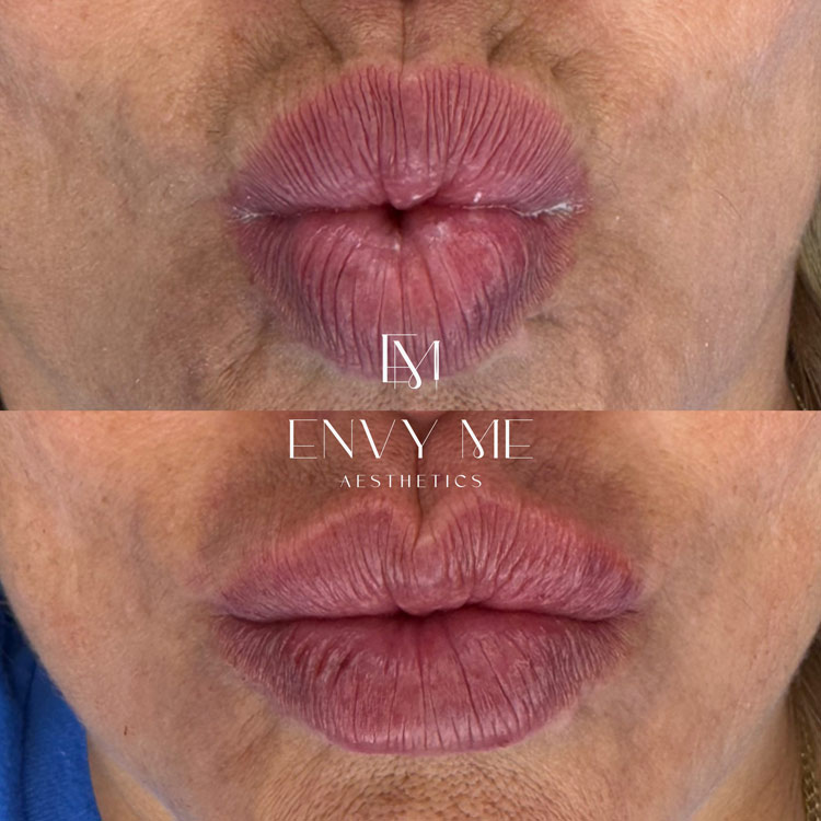 Before and after of a lip filler treatment