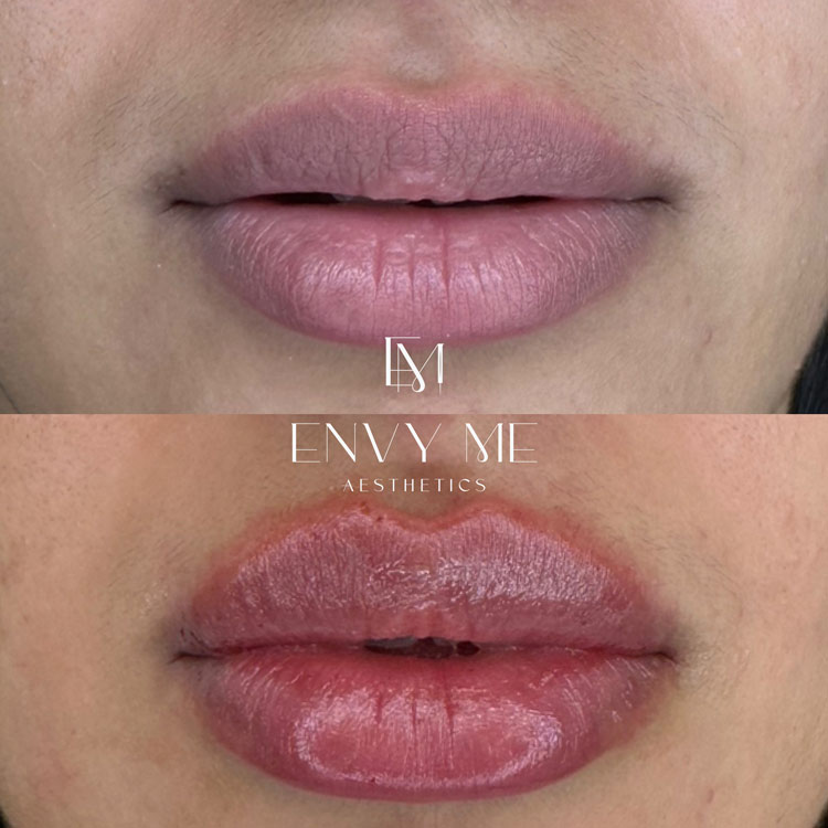 Before and after of a lip filler treatment