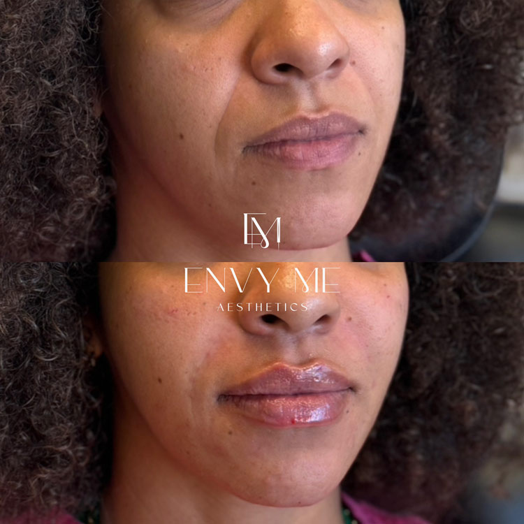 Before and after of a mid and lower face dermal filler treatment
