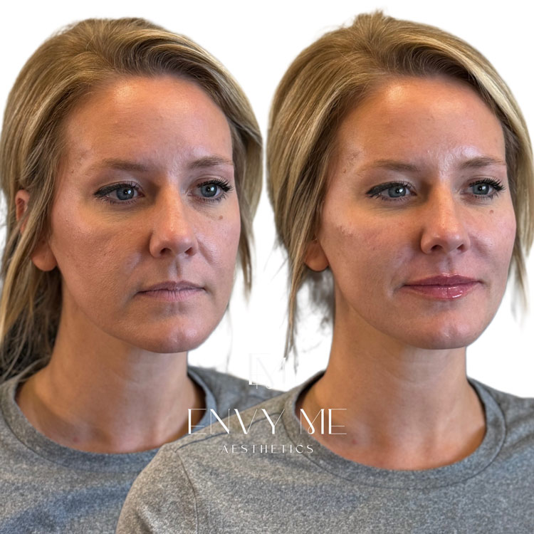 Before and after of a full face dermal filler treatment