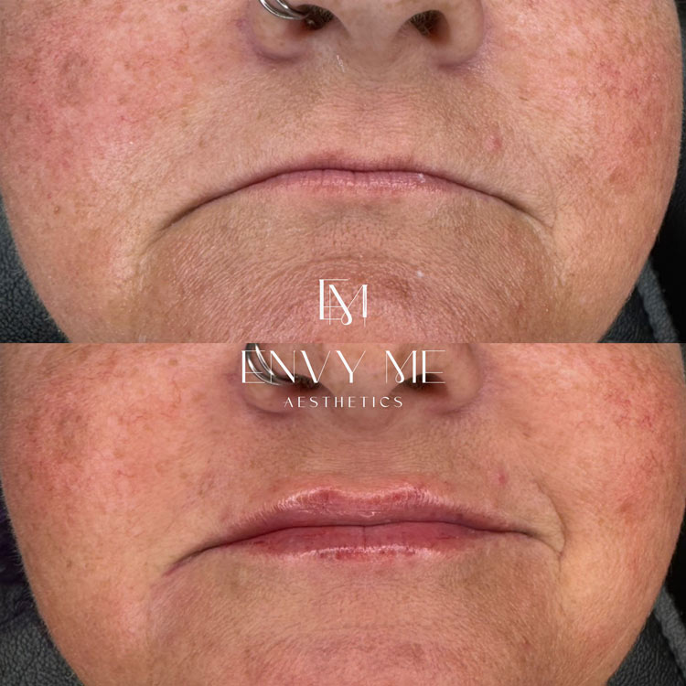 Before and after of a lip filler treatment