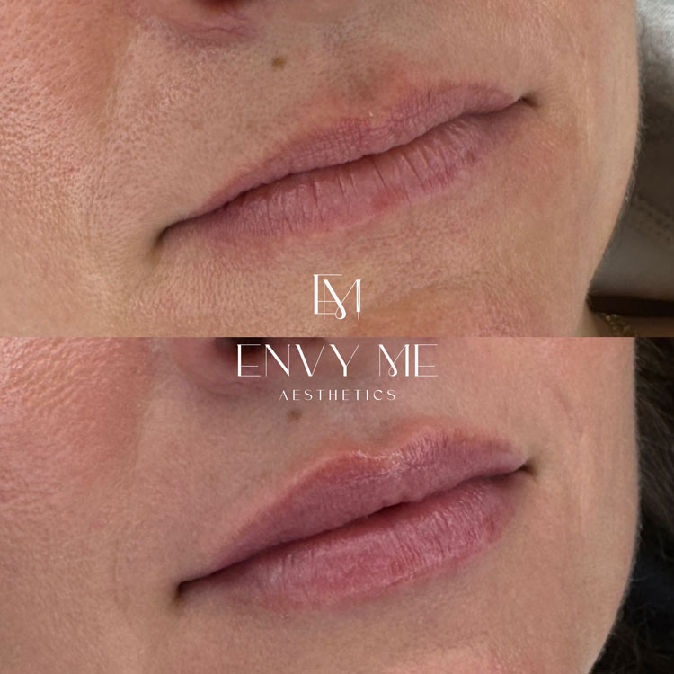Before and after of a lip filler treatment