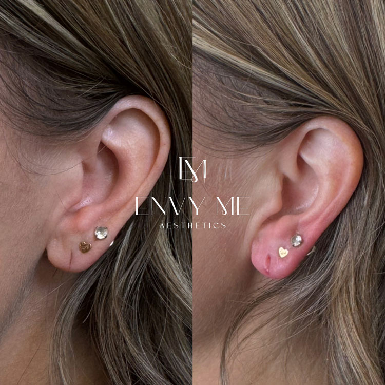 Before and after of an earlobe filler treatment
