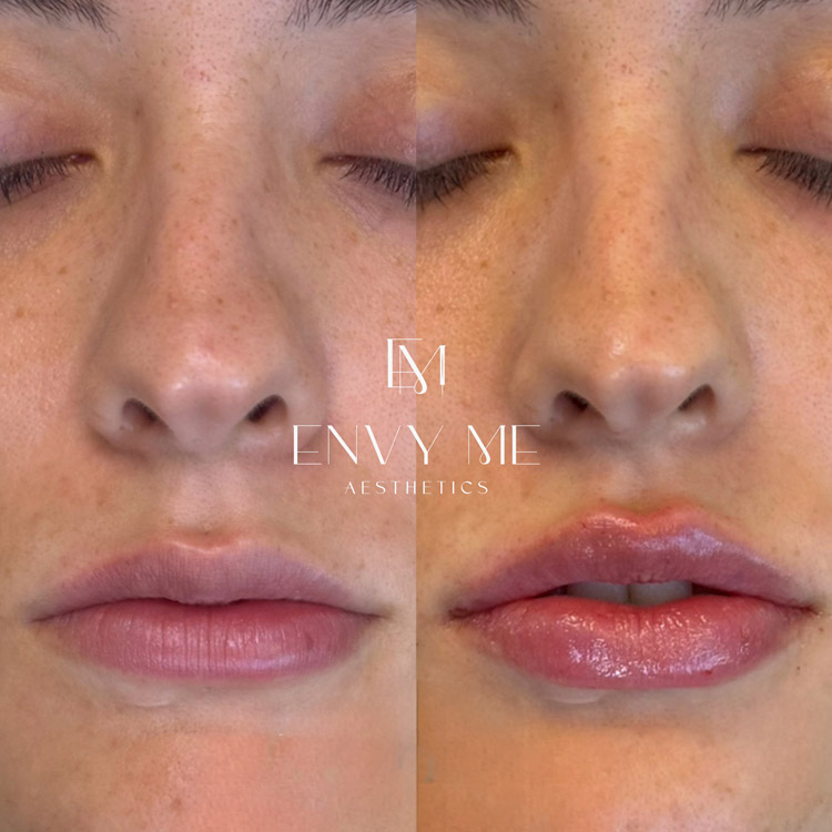 Before and after of a lip filler treatment