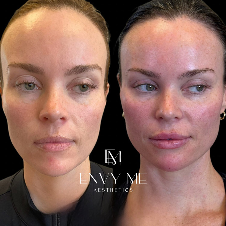 Before and after of a full face dermal filler treatment