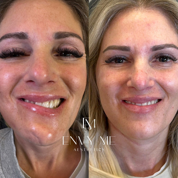 Before and after of post nerve injury correction with neurotoxins