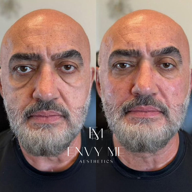 Before and after of mid-face dermal filler