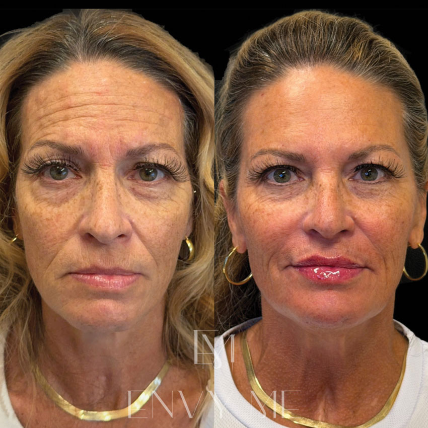 Before and after of an upperface neurotoxin treatment and midface dermal filler