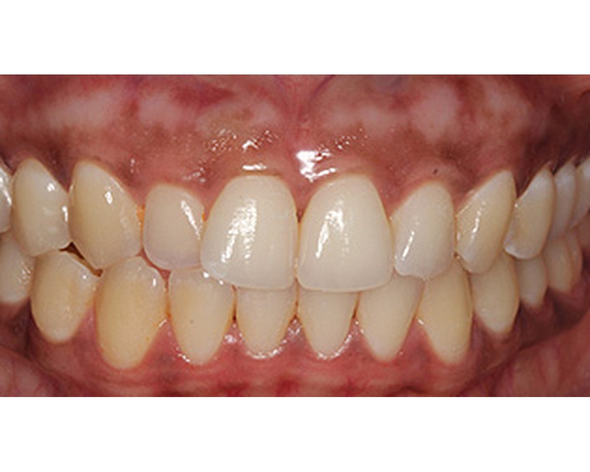 Close-up of teeth and healthy pink gum tissue after laser gum depigmentation