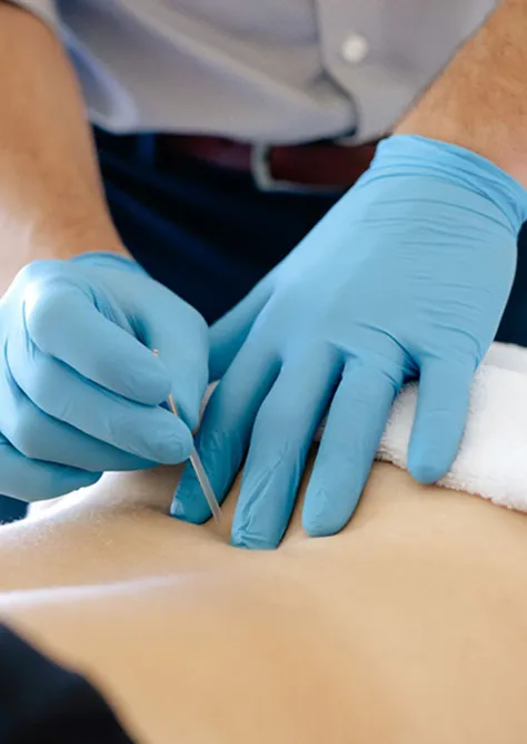 Person wearing blue gloves inserting an acupuncture needle into a person's back.