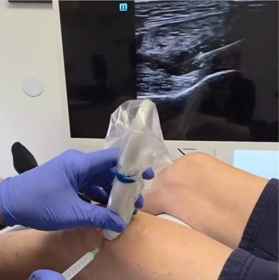 Medical professional wearing blue gloves performing an ultrasound-guided injection on a patient's knee.