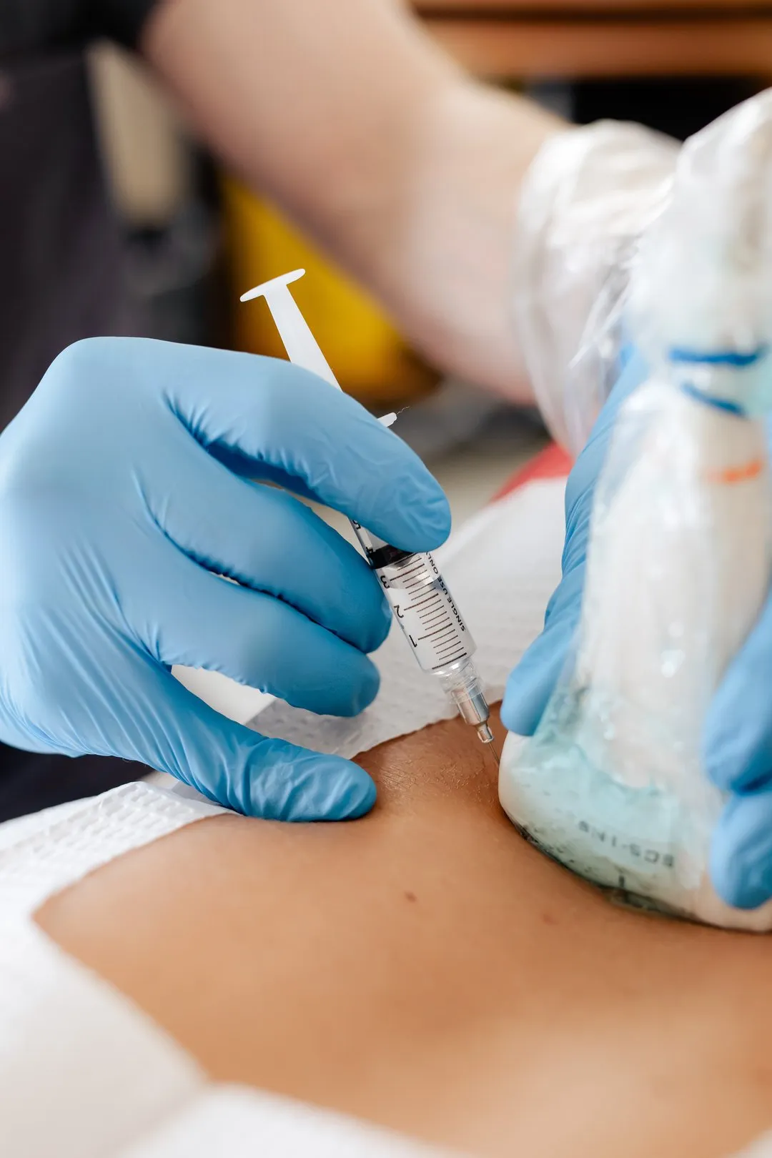 Medical professional with blue gloves uses a syringe for injection on patient's skin.
