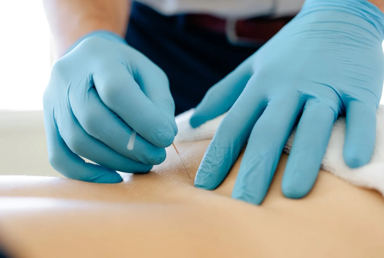 Close-up of hands wearing blue gloves inserting an acupuncture needle into a person's back.