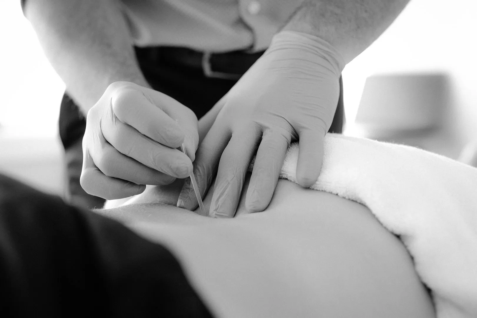 Gloved hands inserting an acupuncture needle into a person's back near a white towel.