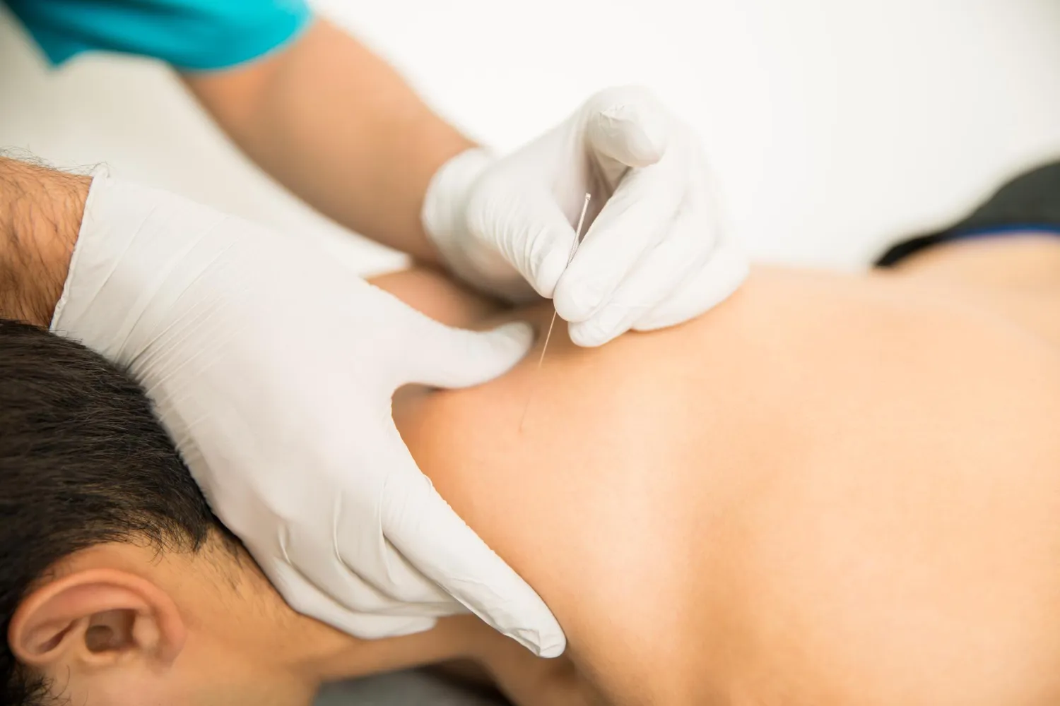 Gloved hands inserting an acupuncture needle into a person's upper back near the shoulder.