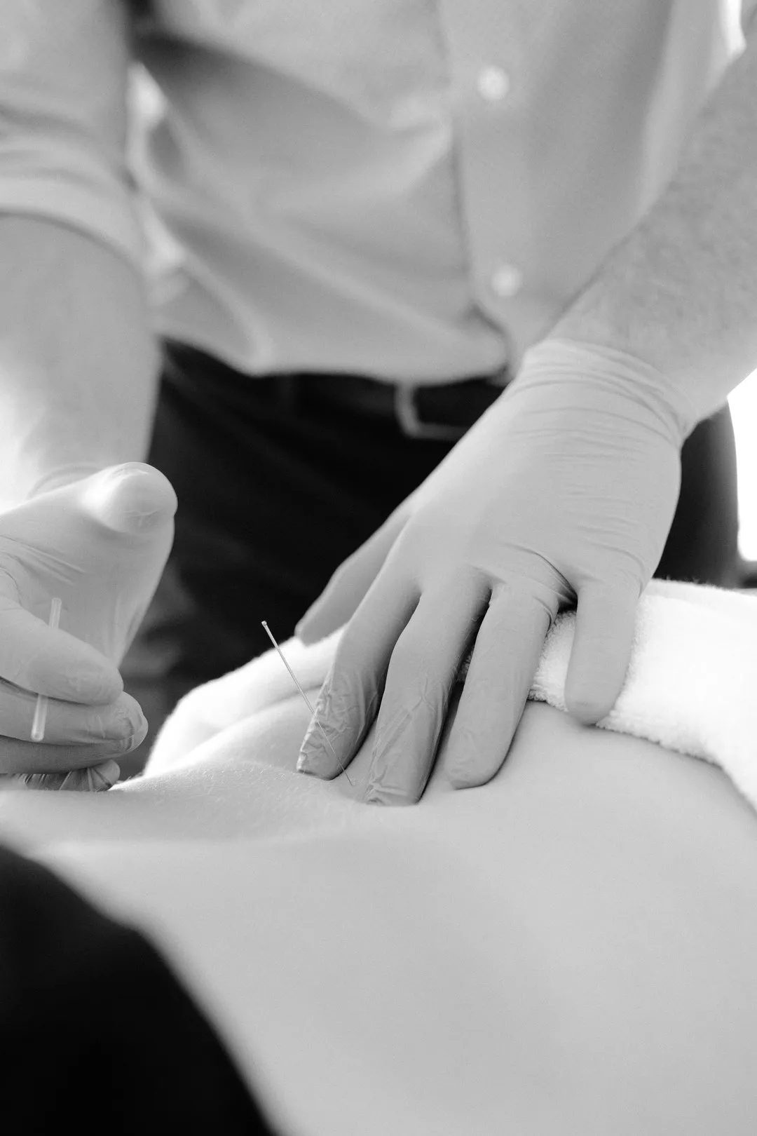 Close-up of gloved hands inserting acupuncture needles into a person's back.