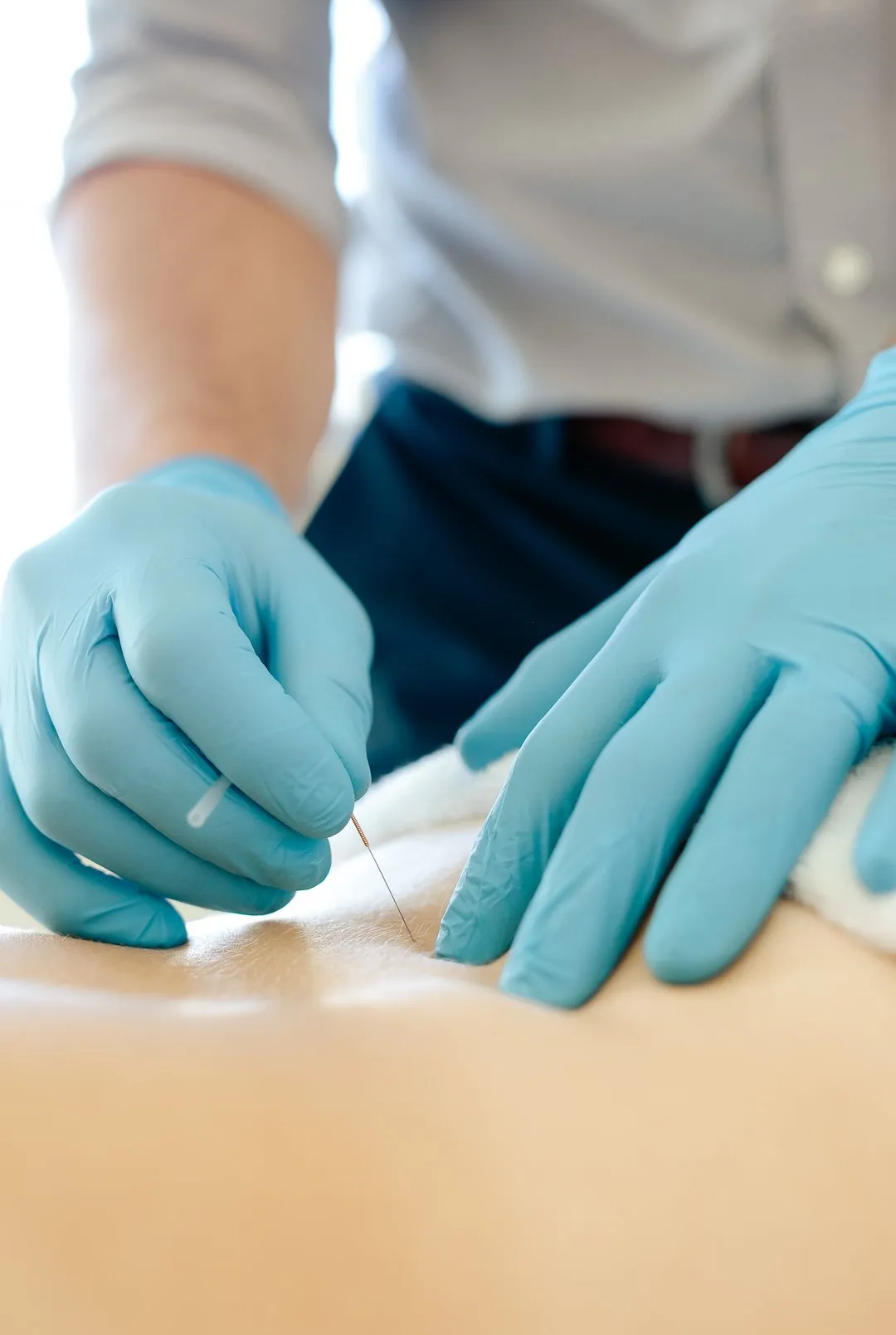 Close-up of hands in blue gloves inserting acupuncture needle into a patient’s back.
