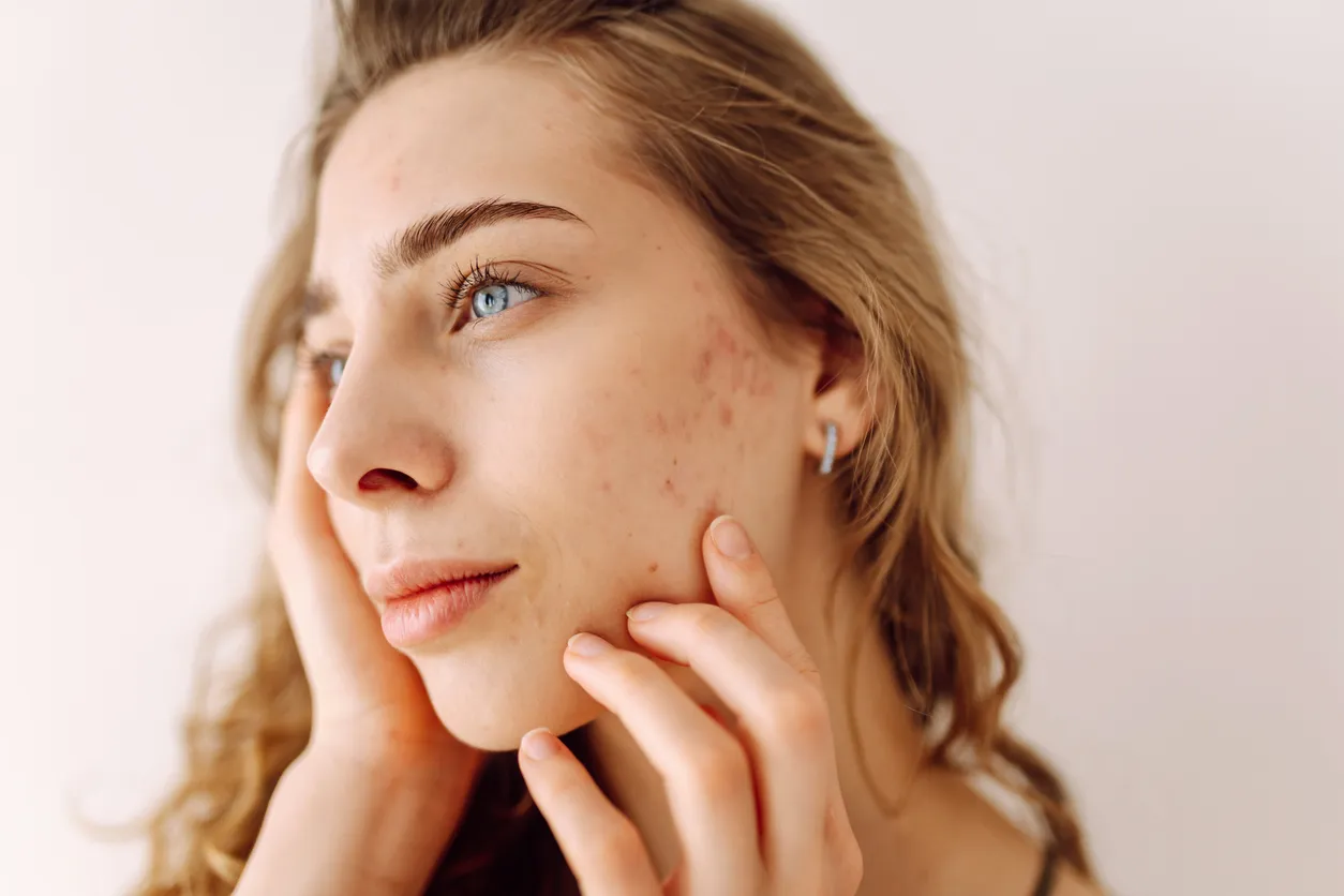 Close-up of young woman with acne scars on cheek touching her face and looking away.