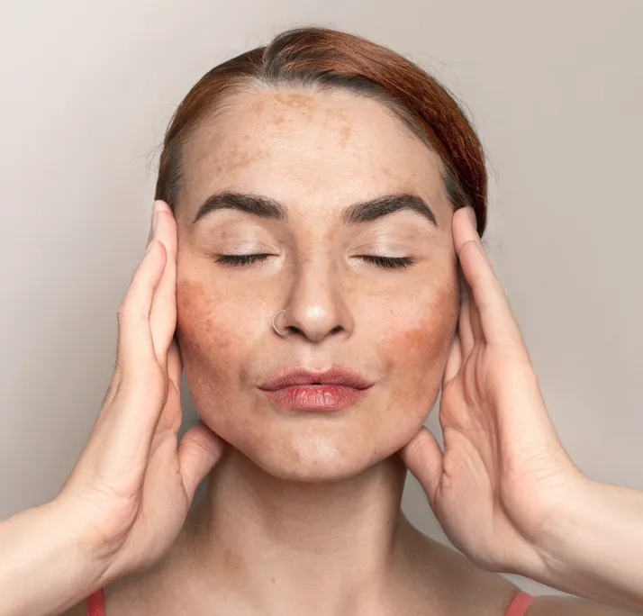 Woman with closed eyes touching sides of her face showing melasma dark patches on her skin.