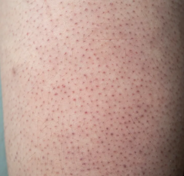 Close-up of skin with keratosis pilaris showing small red bumps and fine hair follicles.