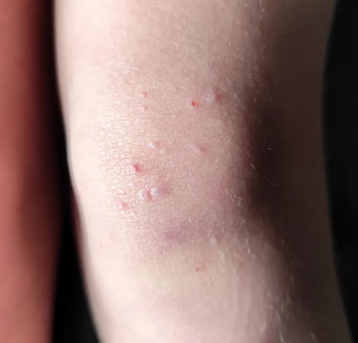 Close-up of skin with small raised bumps and red spots on a pale arm.