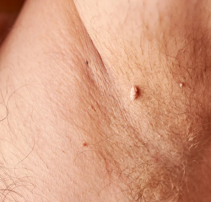 Close-up of skin with multiple small warts and fine hair.