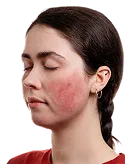 Woman with closed eyes showing red, inflamed rash on her right cheek and jawline.