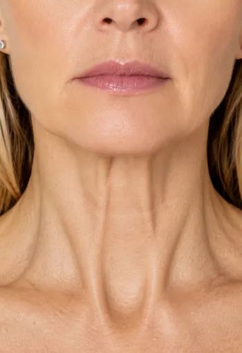 Close-up of a middle-aged woman's lower face and neck showing visible platysmal bands.