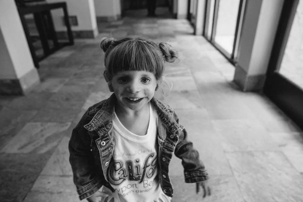 Black and white portrait of a child with a craniofacial condition