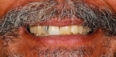Close-up of a smiling man's mouth showing teeth with a thick gray mustache above.