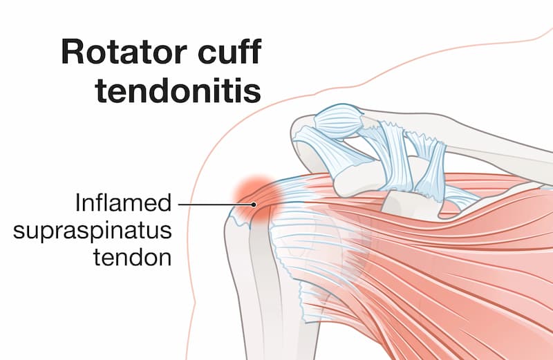Diagram showing rotator cuff tendonitis with inflamed supraspinatus tendon in the shoulder.