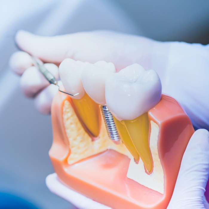 Are You Interested In All-On-Four Dental Implants? Here Are Some Things To Consider!